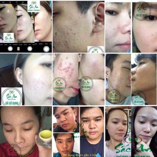ĐÔNG Y TRỊ MỤN-ĐẶC TRỊ MỤN THÂM HOÀN TOÀN TỪ THẢO DƯỢC