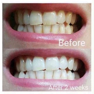 BỘT THẢO DƯỢC TRẮNG RĂNG T-WHITE TRỊ NHIỆT MIỆNG CHẢY MÁU CHÂN RĂNG