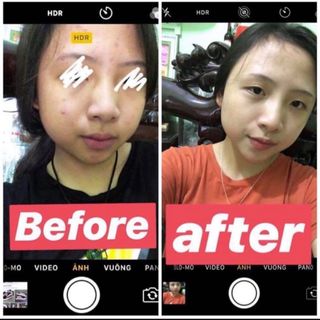KEM TRỊ MỤN QT SKINCARE
