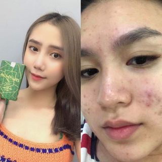 Thảo dược trị mụn nám tàn nhang phục hồi da hư tổn