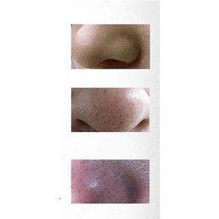 BÁN TỐT Mặt nạ chăm sóc da - trị mụn đầu đen Nội địa trung