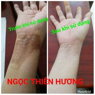 Đặc trị các vết thâm lâu năm