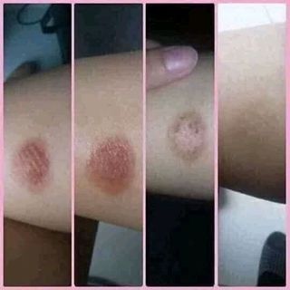 Đặc trị các vết thâm lâu năm