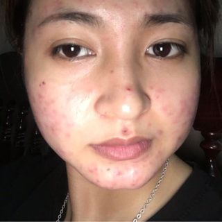 CAO LÁ ĐẶC TRỊ MỤN NGỌC THIÊN HƯƠNG