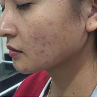 CAO LÁ ĐẶC TRỊ MỤN NGỌC THIÊN HƯƠNG
