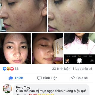 CAO LÁ ĐẶC TRỊ MỤN NGỌC THIÊN HƯƠNG