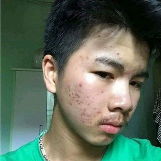 Trị mụn nám tàn nhang Quyên lara
