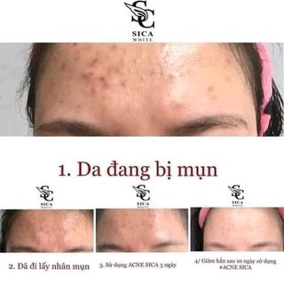 kem trị mụn sica white
