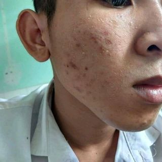 Serum trị mụn nam nữ Herbal Ance