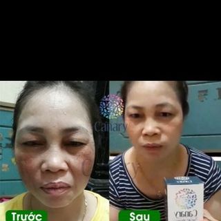 viện uống đặc trị nám da