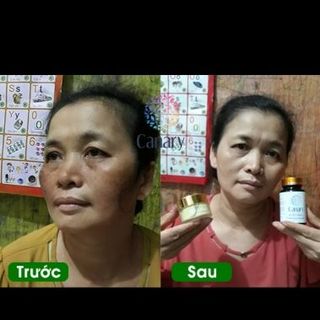 viện uống đặc trị nám da
