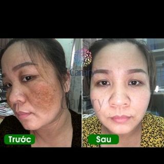 viện uống đặc trị nám da