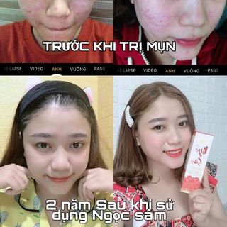 Kem Trị Mụn Không Sưng Đỏ Garnet