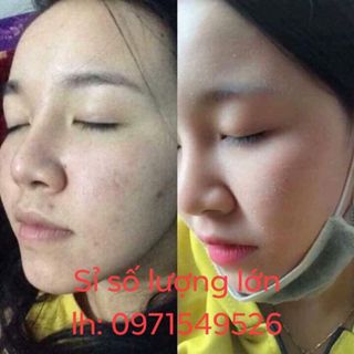 Thuốc Bắc Trị Mụn Tái Tạo Da Đông Y