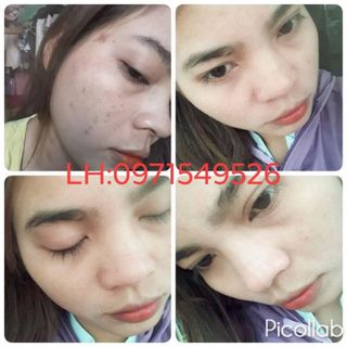 Thuốc Bắc Trị Mụn Tái Tạo Da Đông Y