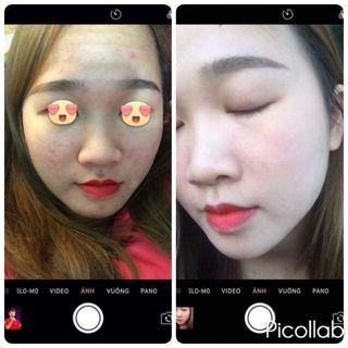 Thuốc Bắc Tái Tạo Trị Mụn Nam Cao Cấp