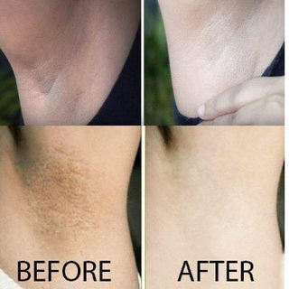 Kem trị thâm nách Q-nic Thái Lan hộp to