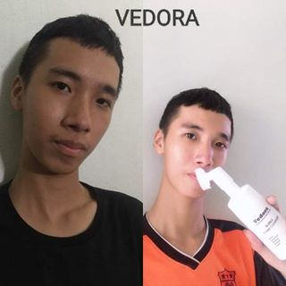 Sữa Rả Mặt Ngừa Mụn Thải Độc Trắng Da VEDORA