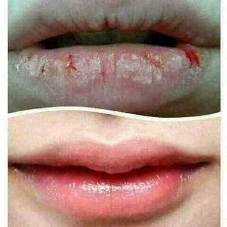 KEM NẺ VASELINE VIỆN BỎNG QUỐC GIA