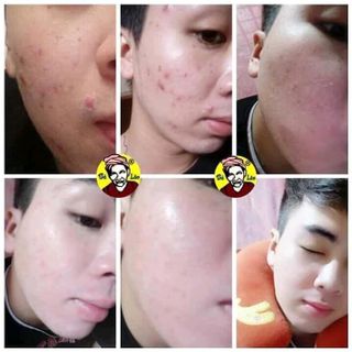 trị mụn bà lão Tái tạo cao cấp