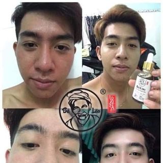 trị mụn bà lão Tái tạo cao cấp