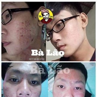 trị mụn bà lão Tái tạo cao cấp