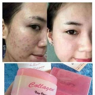 Kem dưỡng trắng trị mụn nám Collagen Plus Vit E 701- Indonesia