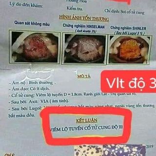 Khỏi viêm lộ tuyến nhờ phụ khoa Nữ Oa