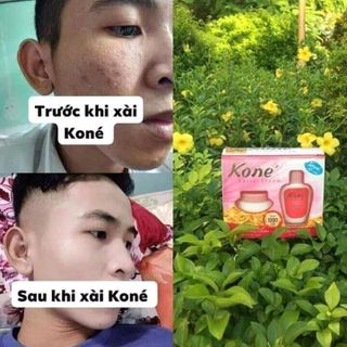 KEM TRỊ NÁM MỤN KONÉ THÁI