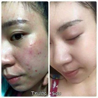 Thuốc trị mụn - nám mẫu đơn thanh mộc hương
