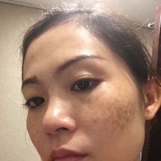 Thuốc trị mụn - nám mẫu đơn thanh mộc hương