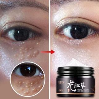 kem trị mụn thit