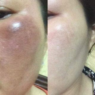 Bộ trị nám Thailand
