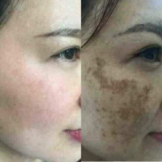 Bộ trị nám Thailand