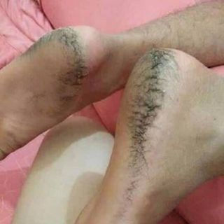 CAO ĐẶC TRỊ NỨT NẺ ĐÔNG Y HỌ NGUYỄN