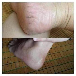 CAO ĐẶC TRỊ NỨT NẺ ĐÔNG Y HỌ NGUYỄN