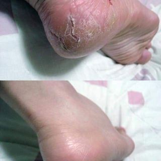CAO ĐẶC TRỊ NỨT NẺ ĐÔNG Y HỌ NGUYỄN