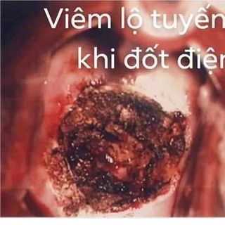 Bí quyết để chấm dứt tình trang viêm lộ tuyến ctc