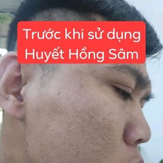 Huyết Hồng Sâmtrị mụn