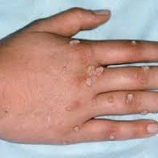 Thuốc đặc trị mắt cá chân chai sừng mụn cóc xuất xứ châu âu hiệu quả và an toàn