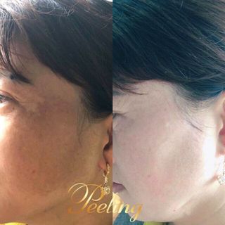Kem Đặc Trị Tái Tạo Da Peeling WHITENING CREAM