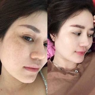 Kem đặc trị MỤN NÁM TÀN NHANG Yanhee thailand