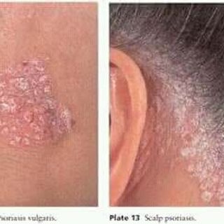 tri rạn da và các vấn đề về dakhông khỏi hoàn tiền