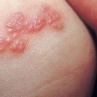 tri rạn da và các vấn đề về dakhông khỏi hoàn tiền