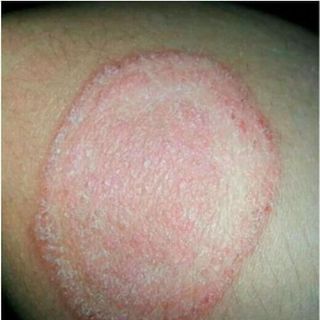 tri rạn da và các vấn đề về dakhông khỏi hoàn tiền