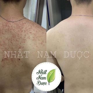 Nhất Nam Dược dạng xịt Trị Mụn Lưng Vai Ngực Viêm Nang Lông