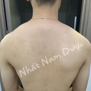 Nhất Nam Dược dạng xịt Trị Mụn Lưng Vai Ngực Viêm Nang Lông