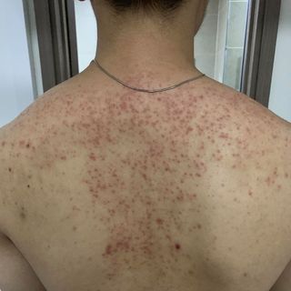 Nhất Nam Dược dạng xịt Trị Mụn Lưng Vai Ngực Viêm Nang Lông