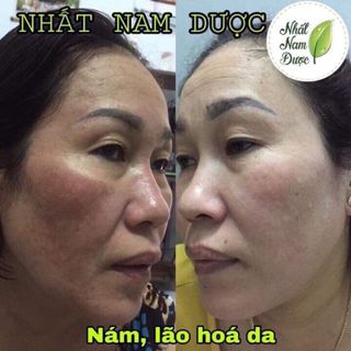 Tinh Chất Trị MụnNÁMSẹo rỗ NHẤT NAM DƯỢC