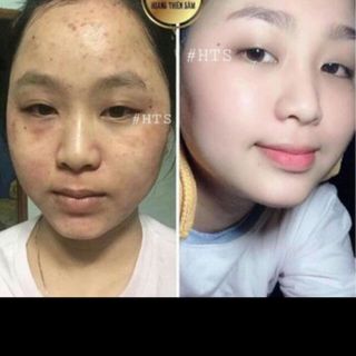 Tinh Chất Tái Tạo Trị Mụn Nám Sẹo Rỗ